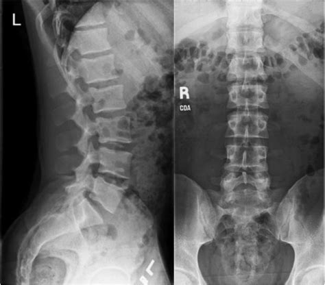 Normal Lumbar Spine X Rays – Lumbar Spine X Ray – XNCNS