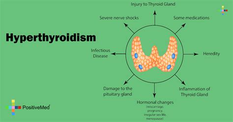 Image result for hyperthyroidism
