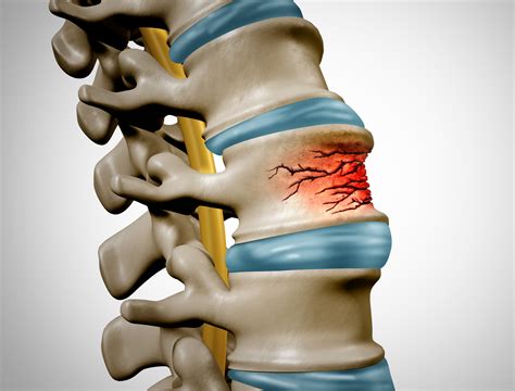 Fractured Vertebrae Treatment