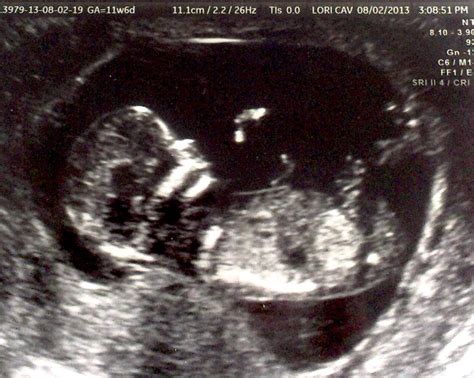 Baby Girl Ultrasound Pictures 13 Weeks at Elizabeth Simson blog