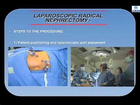 Image result for Nephrectomy Approach