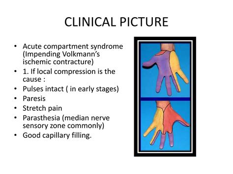 Volkmann¶s ischemic contracture | PPTX