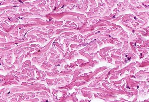 Dense Irregular Connective Tissue Dense Irregular Connective Tissue: