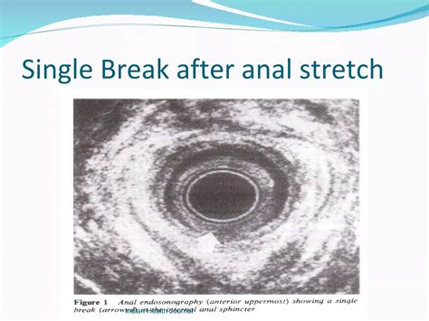 Open lateral internal sphincterotomy | PPT