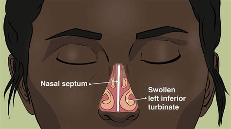 Ibuprofen For Swollen Turbinates at Bonnie Fryman blog