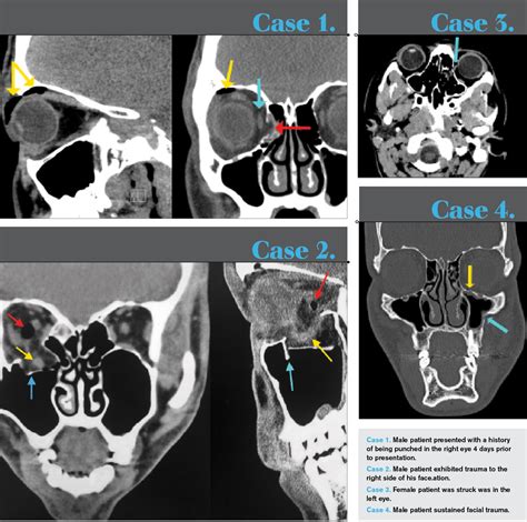 Trapdoor Fracture Orbital Floor Radiology | Viewfloor.co