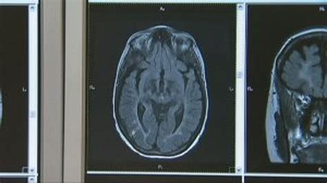 "It's so rewarding:" Multiple Sclerosis Society working closely with ...