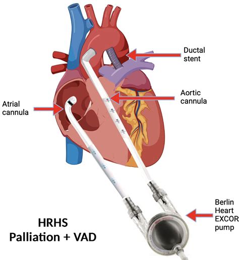 Support with Single Ventricle-Ventricular Assist Device (sVAD) in Patients with Functionally ...