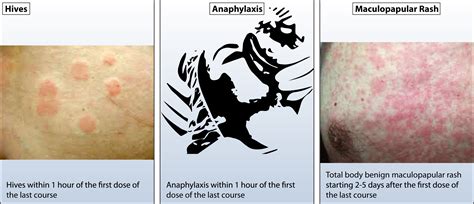 Addressing the epidemic of antibiotic “allergy” over-diagnosis - Annals of Allergy, Asthma ...