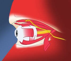 The story of the fourth nerve- The Week