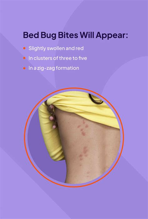 Bed Bug Bites On Legs Bed Bug Rash: How To Know If Your Rash Is From