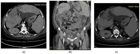 Rare Causes of Portal Vein Thrombosis and Occlusion: A Narrative Review