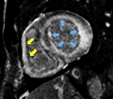 Amyloidose als Ursache von Herzinsuffizienz mit erhaltener EF ...