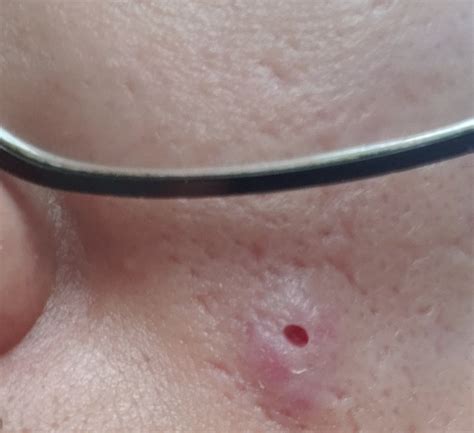 Large hole on face after getting a pimple : r/Dermatology