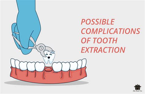 Image result for What Is a Complex Tooth Extraction