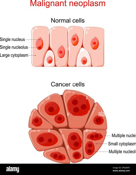 Malignant neoplasm. Cancer and Normal cells. comparison and difference between healthy tissue ...
