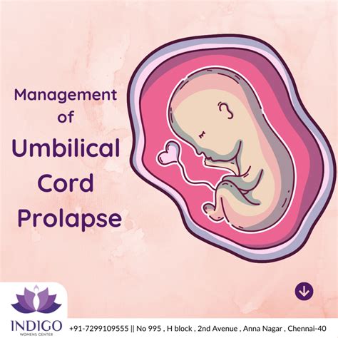 Umbilical Cord Prolapse – Indigo Woman Center