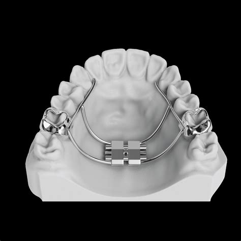 Rapid Palatal Expander | ODL Orthodontic Labs
