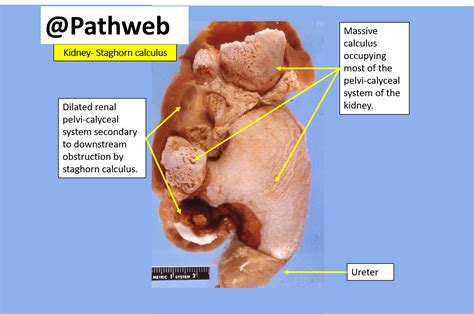 Hydronephrosis Kidney Stone