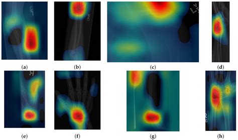 Classification and Visualisation of Normal and Abnormal Radiographs; A ...