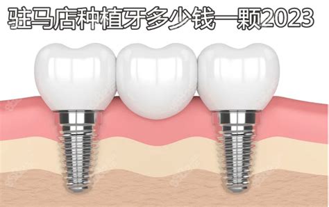 兰州诺贝尔口腔瑞典诺贝尔ACTIVE种植体价格18075元起，质量超好_兰州诺贝尔口腔门诊部_皓齿口腔网