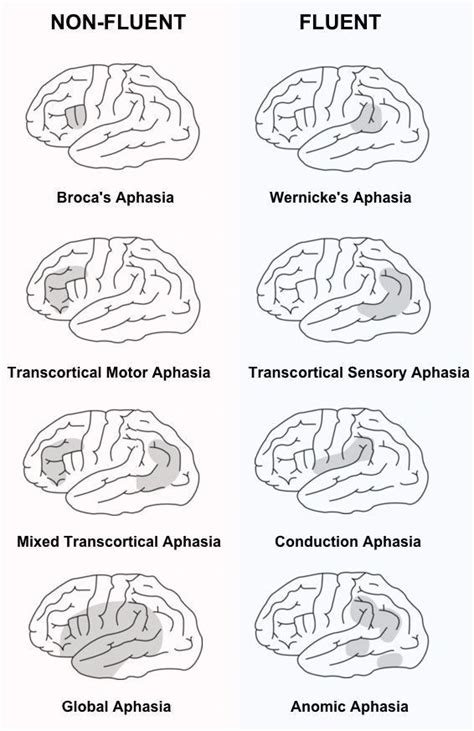 Image result for Aphasia Types Chart Fluent