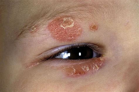 Psoriasis On Eyelid