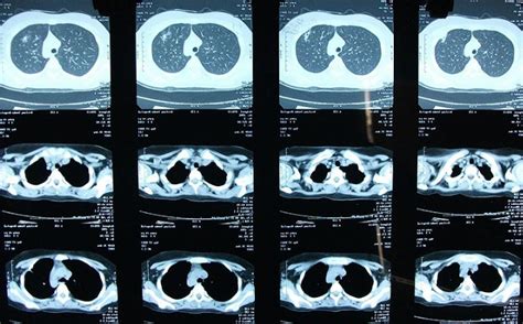 肺结核 ct正常 – 肺结核ct片图片图解 – Monacom