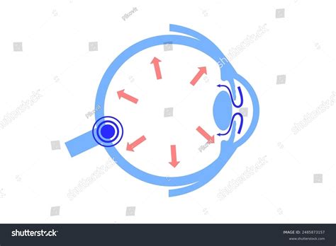 Glaucoma Poster Increased Intraocular Pressure Damaged Stock Vector (Royalty Free) 2485873157 ...