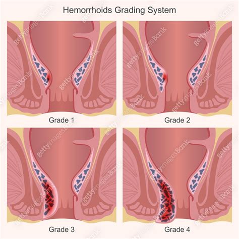Hemorrhoids are categorized into 4 grades. 이미지 (2188651994) 일러스트, 무료 ...