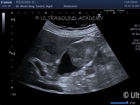 CA GALL BLADDER – Case By Dr. Nitin Jadhav