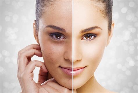 Pigmentation | M A Skin & Hair Superspeciality Clinic - Dr. Manoj ...