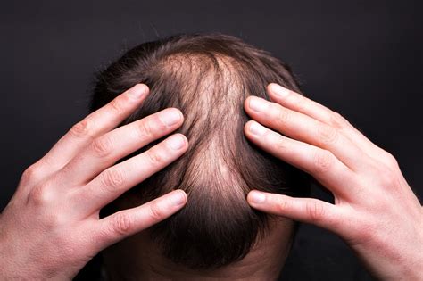 Foods that cause hair fall in men – mars by GHC