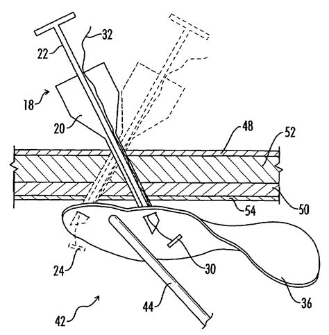 Device and method for surgical repair of abdominal wall hernias - Eureka | Patsnap