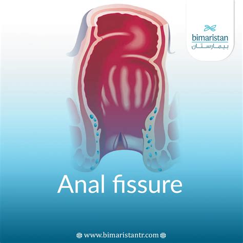 Anal Fissure: Main Causes and Treatment Methods - Bimaristan