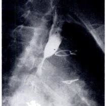 Image result for Exploratory Thoracotomy