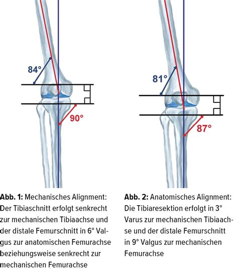 Standards und neue Konzepte des Alignments in der Knieendoprothetik ...