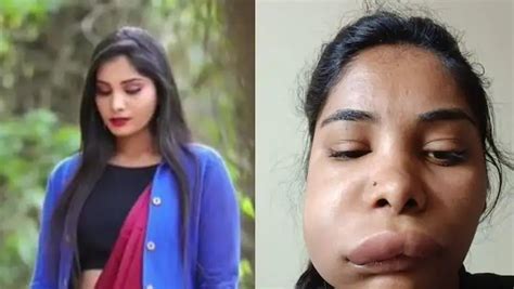 खूबसूरती बढ़ाने के लिए कन्नड़ एक्ट्रेस ने कराई सर्जरी, बिगड़ गई पूरी ...