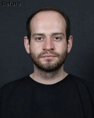 Incredible Grafts Hair Transplant Before and After: Hair Restoration ...