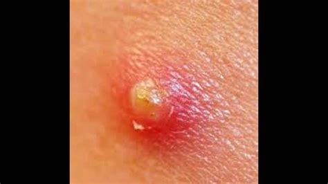 Image result for Removing Carbuncle