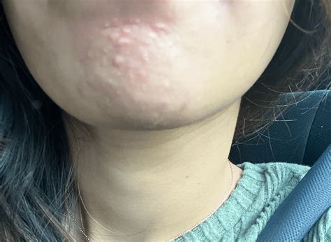 Hypertrophic Acne Scar