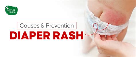 Diaper Rash in Babies: Causes, Prevention & Care Tips