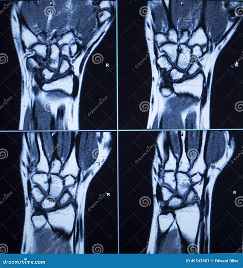 MRI Scan Test Results Wrist Hand Injury Stock Photo - Image: 49543907