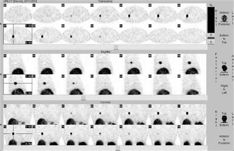 Image result for Poumon Normal Scanner