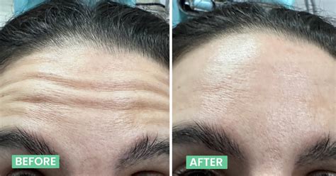 Best Botox & Fillers Treatment in Bangalore: Price, Benefits