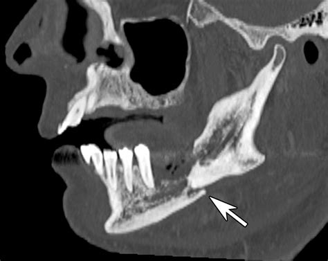 Practical Approach to Radiopaque Jaw Lesions | RadioGraphics