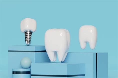 Full Mouth Implants: Achieving a Full Smile Makeover