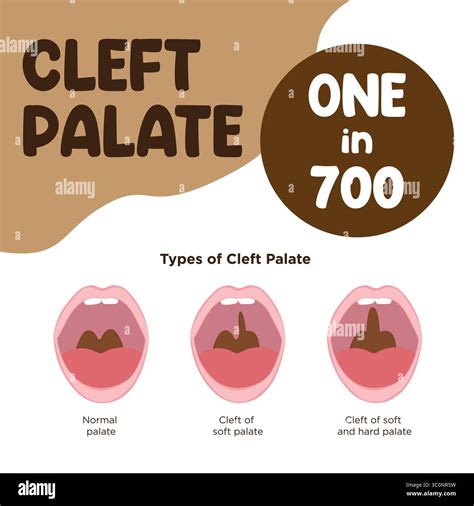 Normal, unilateral cleft lip and palate, and bilateral cleft lip and ...