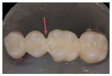 Fixed Partial Denture Meaning In Malayalam at William Stork blog