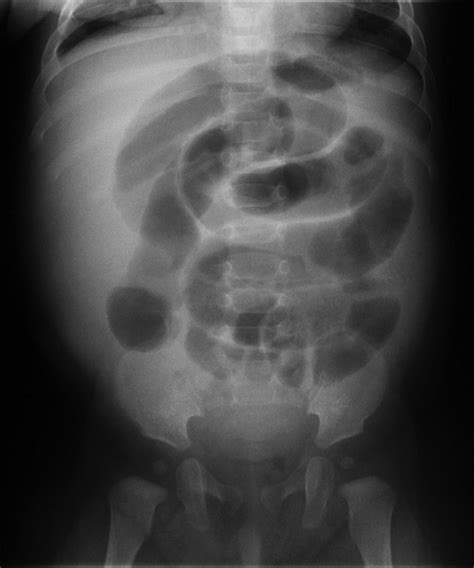 Imaging and intussusception | ADC Education & Practice Edition